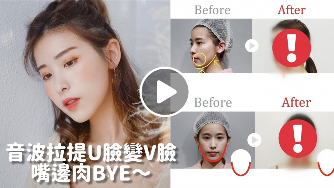 音波拉提讓你變Ｖ臉 嘴邊肉掰掰｜松凌愛漂亮